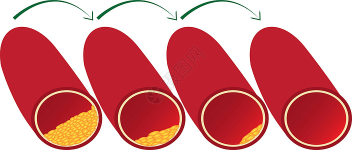 清理和减少动脉粥样硬化斑块血管血液的使用心脏插图心脏病学验血疾病实验室诊断水平测试心脏病图片