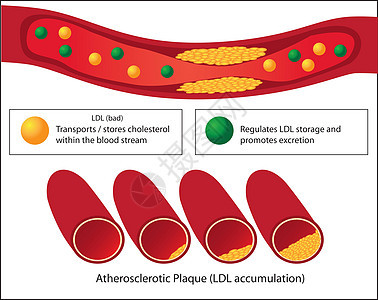 好血脂和坏血脂以及动脉粥样硬化斑块水平在血管医学中的作用图片