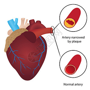 血管中的胆固醇水平图片