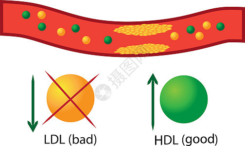 血管中的动脉粥样硬化斑块 血液中好血脂和坏血脂的调节图片