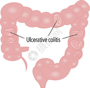 溃疡性结肠炎肠道疾病诊断冒号消化系统插图器官憩室溃疡人体身体腹部图片