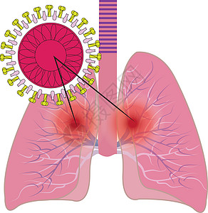 受冠状病毒感染 COVID1 影响的肺部痛苦疼痛疾病测试汇率感染微生物学药品技术实验室图片