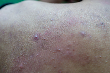 背面的Acne Acne肤色护理缺陷化妆品药品疾病卫生皮疹瘢痕青少年图片