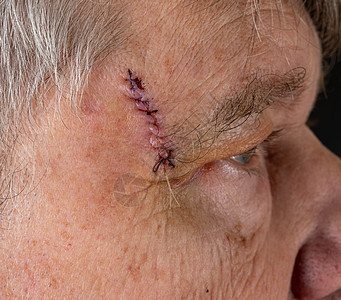 外科手术后老年人的侧视角 以去除伤口上的皮肤癌缝针男性病人损害老年晒黑癌症皮肤男人身体医疗图片