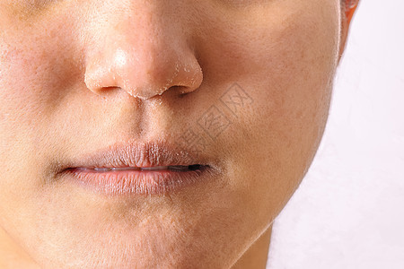 过敏妇女冬季的鼻和嘴唇有湿疹干鼻子和嘴唇cl老化裂缝男人沙漠胡须面具皮肤裂纹戏剧性干旱图片