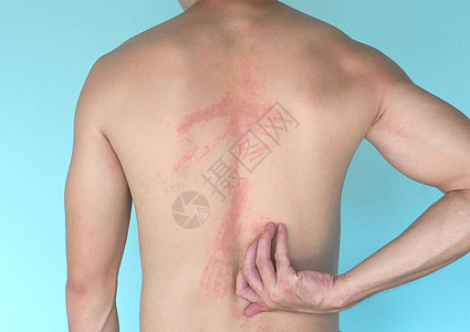 近身人手抓着背皮肤过敏皮疹 健康症状医疗湿疹痛苦治疗身体感染皮炎男人病人图片