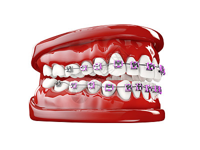 带托槽的牙齿牙齿护理概念 3d 它制作图案磨牙支撑牙科牙医药品凹痕金属矫正宏观插图图片