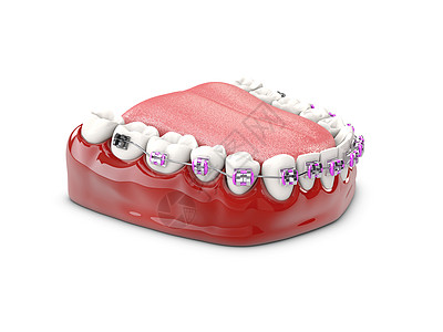 带托槽的牙齿牙齿护理概念 3d 它制作图案治疗卫生牙科医生微笑矫正插图磨牙化妆品凹痕图片