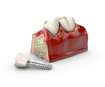 3个牙齿牙牙植入模型插图手术空腔外科诊所医生植入物牙医治疗凹痕假肢图片