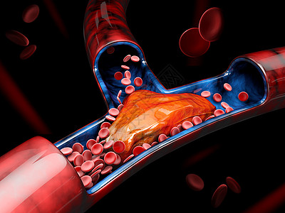 3d 深肠血栓或血衣说明生物学疾病阀门渲染栓子细胞绘画动脉粥样硬化动脉硬化3d图片