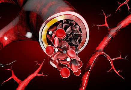 镰状细胞贫血 用正常和失格式的日新月亮3D插图显示血液容器遗产解剖学小体动脉血清图表疾病宏观贫血流动图片