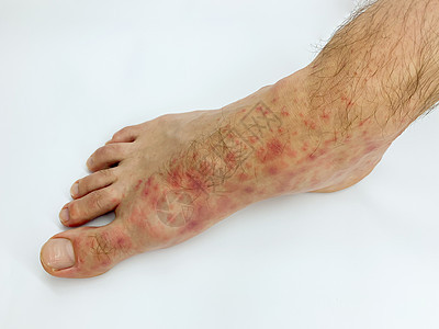 雄性的脚跟和脚趾贴近了 发红疹发炎疾病侵蚀皮炎皮肤细菌治疗身体医生湿疹疼痛背景图片