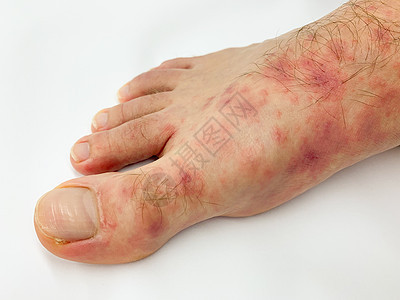 雄性的脚跟和脚趾贴近了 发红疹发炎皮疹湿疹疼痛侵蚀症状麻疹男性皮肤细菌昆虫图片