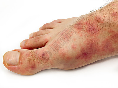 雄性脚和脚趾靠近 红疹发病隔离男性皮肤昆虫细菌麻疹感染皮肤科治疗症状风疹图片