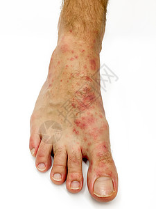 雄性脚和脚趾靠近 红疹发病隔离治疗男性麻疹皮疹疼痛细菌症状疾病医生身体图片