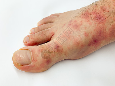雄性的脚跟和脚趾贴近了 发红疹发炎疼痛细菌昆虫症状皮疹表皮身体皮肤感染麻疹图片