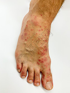 雄性的脚跟和脚趾贴近了 发红疹发炎治疗感染身体麻疹皮肤科表皮细菌症状昆虫湿疹图片
