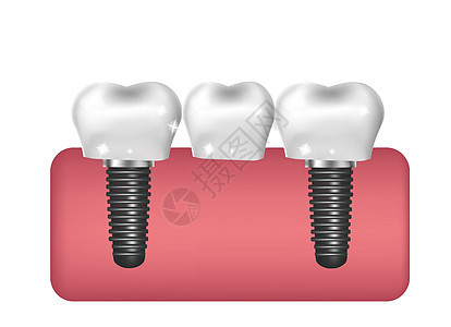牙科植入物桥梁建设假肢 3D 逼真的风格 牙科健康牙齿的概念 它制作图案矢量图片