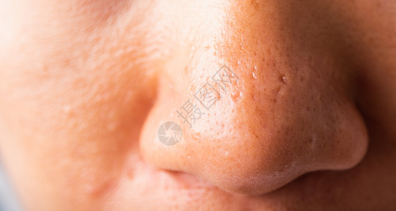 女人大的毛孔有雀斑脸颊油润滑 鼻子上刺鼻白头女孩瑕疵细菌皮肤科成人皮脂卫生女士女性背景图片