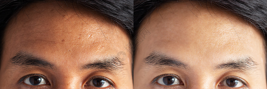 两张图片对比治疗前后的效果 治疗前后有雀斑 毛孔 暗沉 额头皱纹等问题的皮肤 解决皮肤问题 让皮肤变好图片