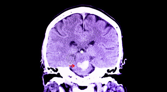 脑膜出血病人中风药品治疗射线手术高血压断层解剖学截瘫图片