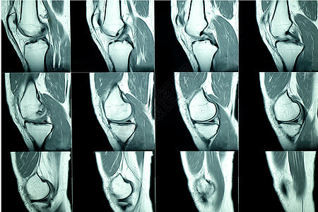 MRI 病人膝盖MRI扫描图片