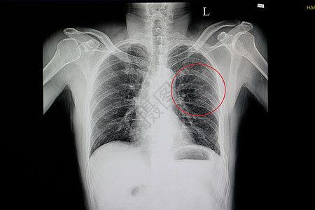 受伤害病人钝胸胸壁的刀锋胸部X光片图片