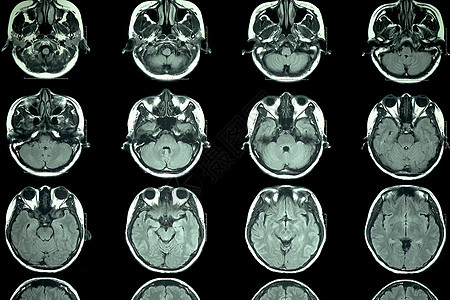 脑部核磁共振成像扫描电脑放射科技术x射线科学治疗射线测试病人考试图片