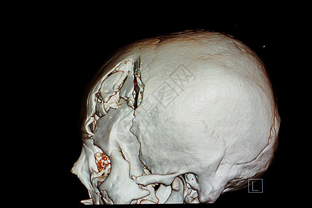 脑外伤患者头骨的 3D 渲染胶片疾病药品医生外科颅骨解剖学创伤诊断轨道医院图片
