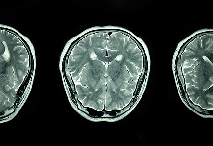 脑部核磁共振成像扫描解剖学病人科学射线辐射实验室白色疾病医院测试图片