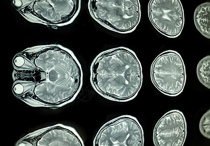 脑部核磁共振成像扫描x射线颅骨药品科学考试解剖学谐振电脑白色辐射图片