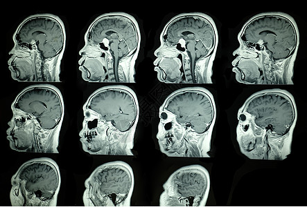 脑部核磁共振成像扫描诊断医疗考试电影放射科解剖学治疗测试白色病人图片