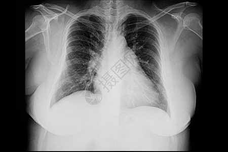 心脏病解剖学医院放射科胸部诊断骨骼x光病人射线胸膜图片