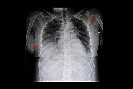 右肺渗入和右心肠导管图片