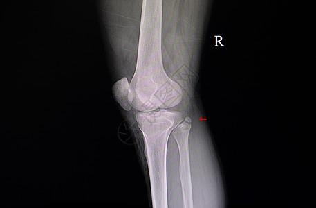 X射线薄膜 显示骨折近度纤维图片