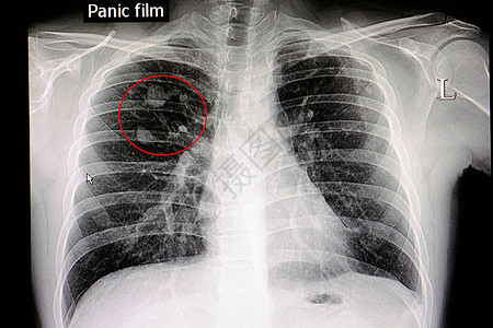 肺结核医院白色解剖学电影药品射线扫描疾病胸部病人图片