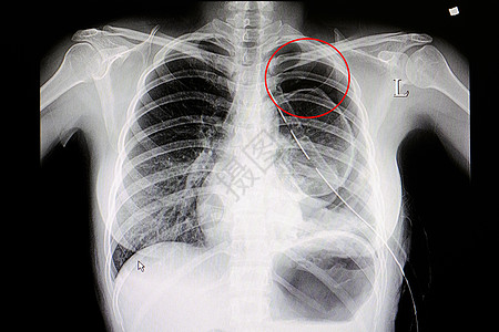 肺炎mothorax疾病x光身体医院骨骼扫描射线胸部白色解剖学图片