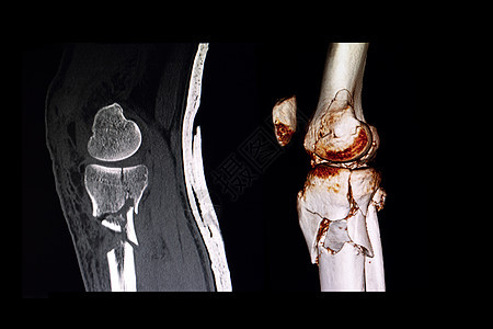 CT扫描和3D计算机传送膝盖图像图片