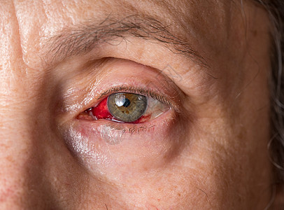 高龄女性眼神紧贴与结膜炎或粉红眼睛 在虹膜周围图片