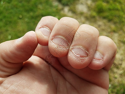 食指指甲坏习惯 不健康 完全被咀嚼的恶习痛苦手指背景图片