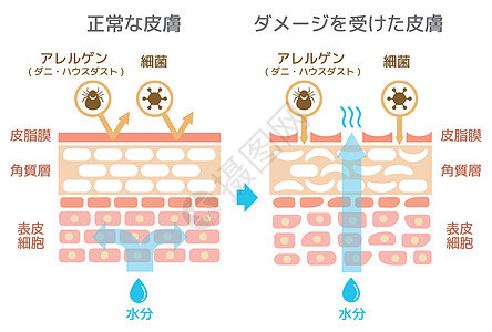 皮肤剖面图 健康皮肤与受伤皮肤保护效果对比图解剖学保健过敏真皮细菌障碍皮脂损害横截面药品图片
