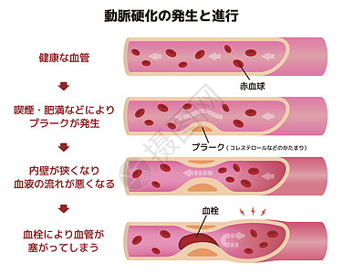 血栓形成中风科学高清图片