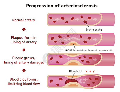 动脉硬化它制作图案的进展中风血栓血管压力静脉细胞外科封锁牌匾科学图片