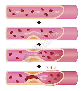 动脉硬化它制作图案的进展手术插图心血管封锁梗死流动身体血管动脉心肌图片