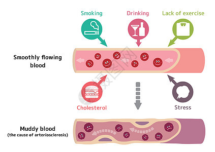 健康血液因各种不健康因素导致动脉硬化而变得浑浊的例证流动压力药品身体科学心肌封锁手术血栓外科图片