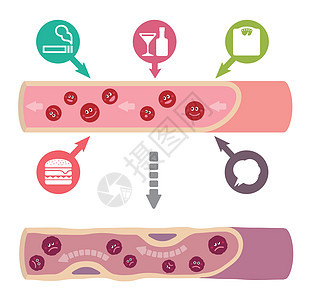 健康血液因各种不健康因素导致动脉硬化而变得浑浊的例证牌匾心血管解剖学身体动脉形成科学细胞外科压力图片