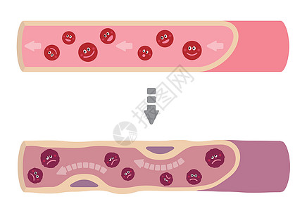 健康血液因各种不健康因素导致动脉硬化而变得浑浊的例证科学疾病载体静脉中风梗死动脉解剖学攻击插图图片