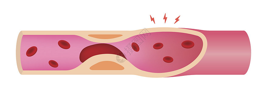 它制作图案被血块堵塞的动脉图片