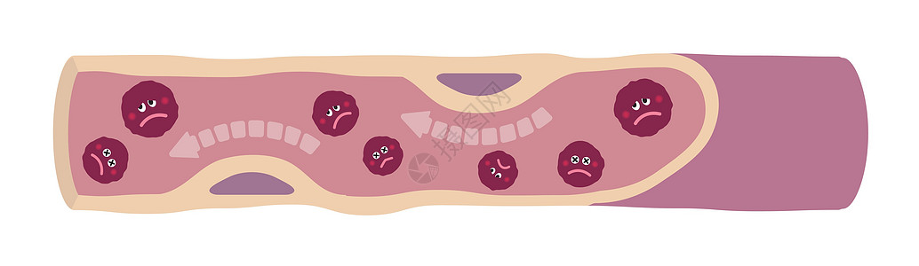 浑浊血管的卡通插图图片