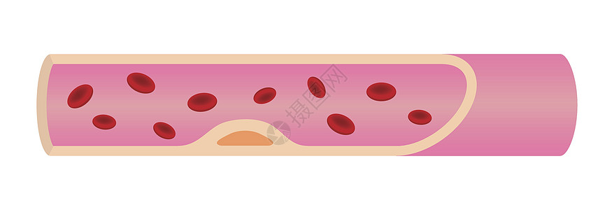动脉硬化血管早期它制作图案图片